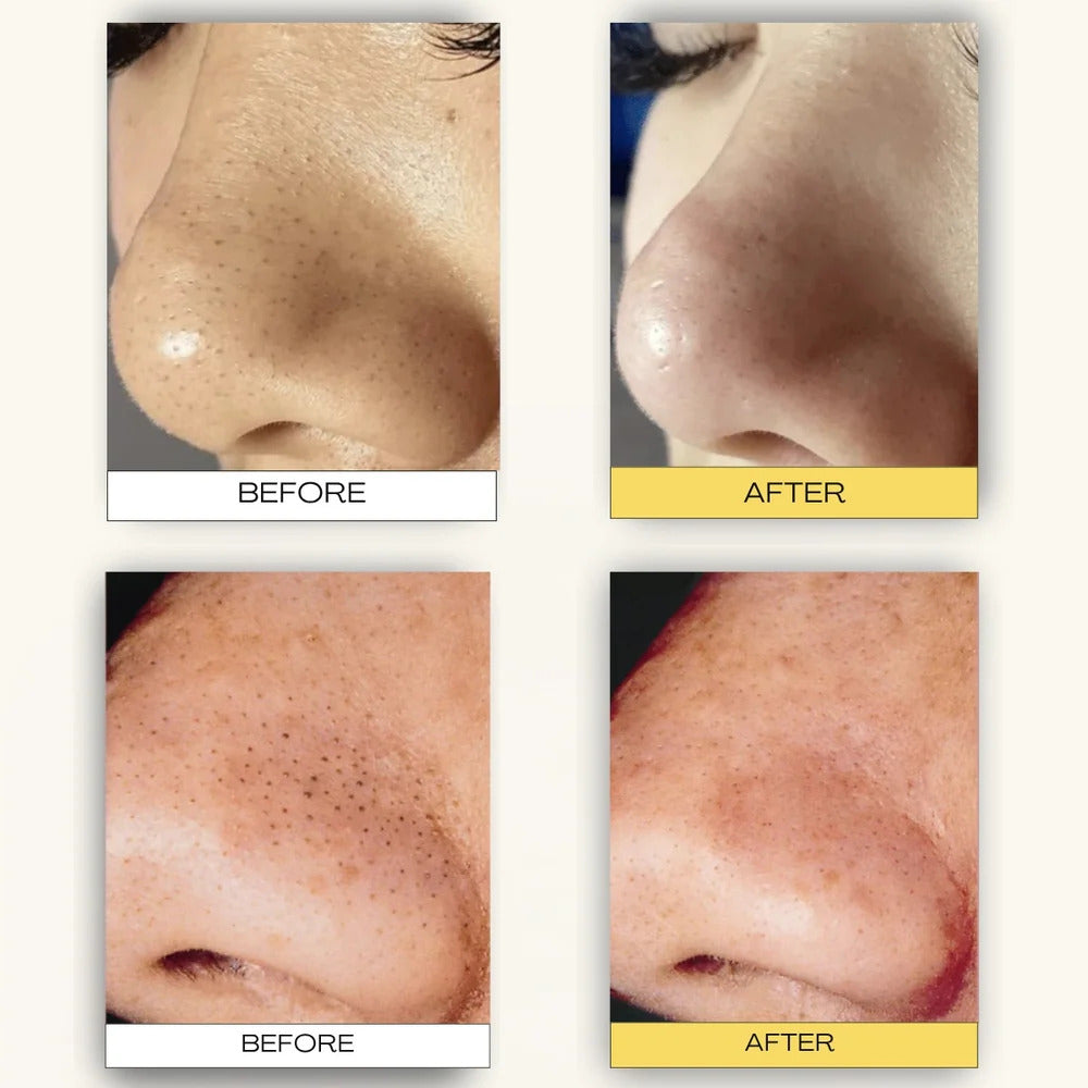 Nose plant pore strips