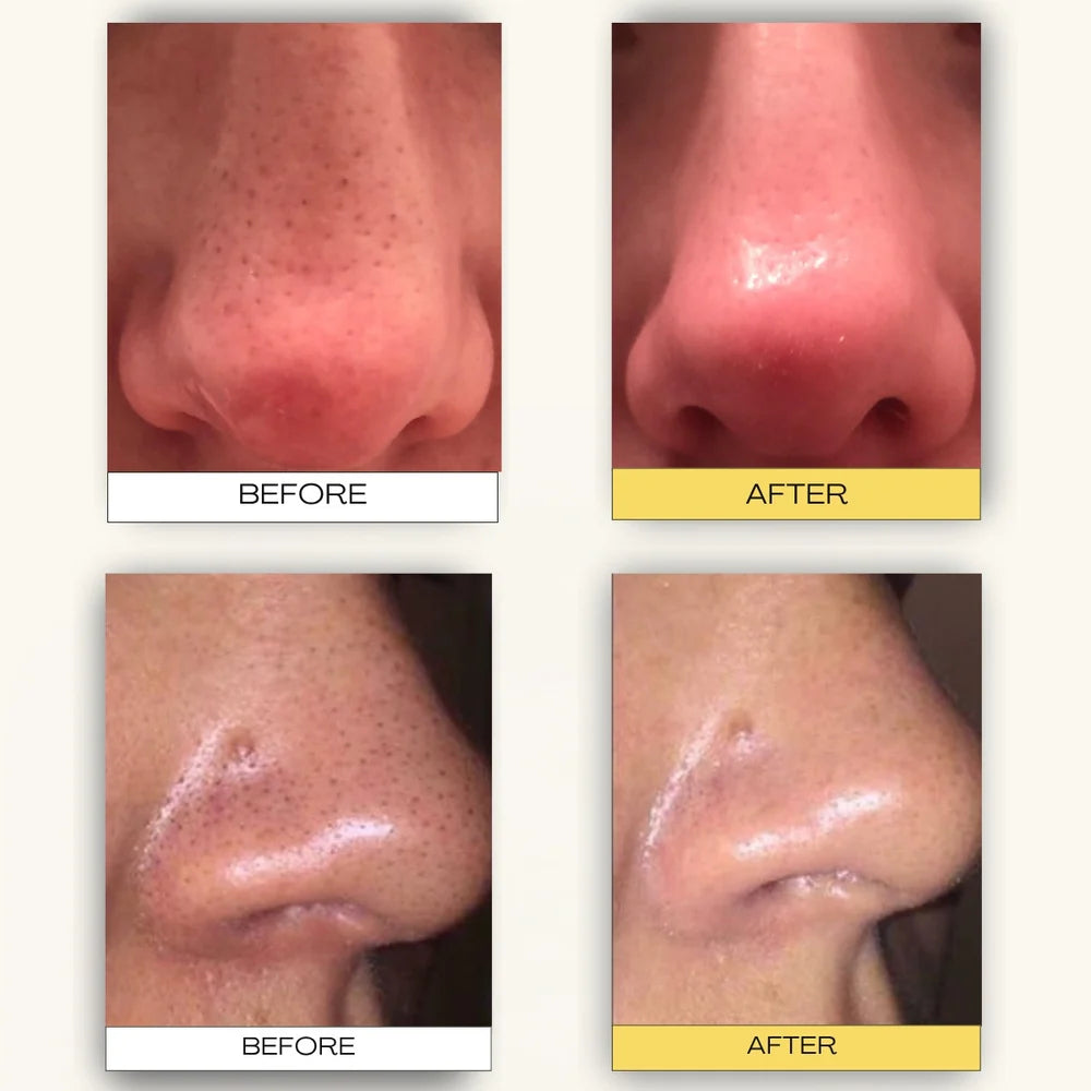 Nose plant pore strips